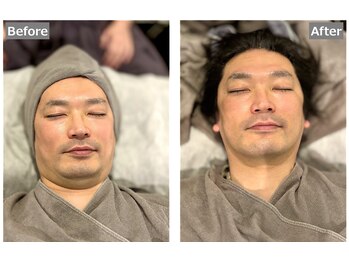 カリド ラボ(CALIDO LAB)/驚異！！エレブラ効果♪施術前後