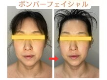 コトハ(cottha)/1回施術後