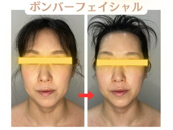 コトハ(cottha)/1回施術後
