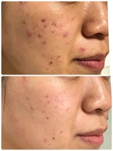 美プラス/《20代》ピーリング×スキンケア