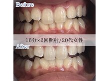 ホワイトニングカフェ 藤が丘店(WhiteningCafe)/2回分照射☆