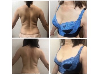 美人バスト 犬山店/背中痩引き締め/バストアップ