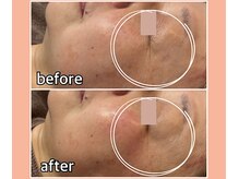 浜松富塚ベルミーランド/フェイシャルBefore→After