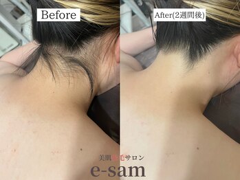 イーサム(e-sam)/丸ごと全身脱毛