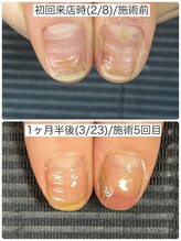 ウェルズユキ(well's yuki)/割れやすい爪