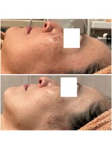 リッツ 大宮店/【Before/After】しみ改善