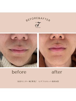 ナナ(nana)/◆before/after◆