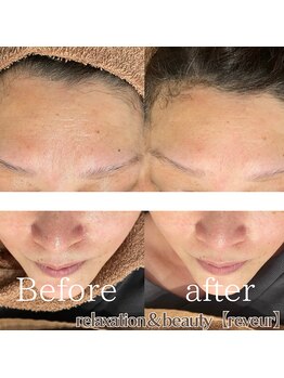 レヴール(reveur)/ハーブピーリングで美肌ケア