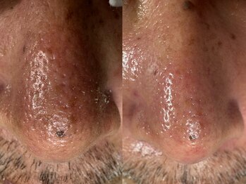 サラグランデ(Sara Grande)/男性毛穴ケア 大人気♪