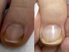 【foot】巻き爪改善ジェル　￥5000→