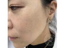 ハーバリー ハーブピーリング 岐阜(HERBERRYハーブピーリング)/ハーブピーリング専門店HERBERRY