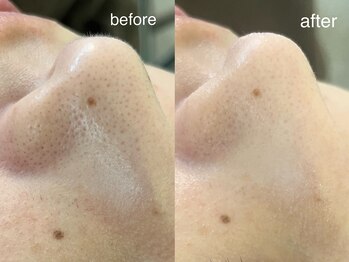 テオリア(TEORIA)/ザラつきOFF!