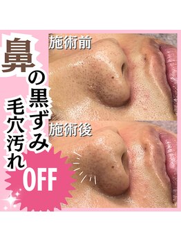 ホワイトワックス 名古屋金山店(WHITE WAX)/鼻の黒ずみ・毛穴汚れオフ