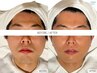 【メンズ脱毛】　毛穴洗浄＋ヒゲ脱毛　皮脂汚れを取って清潔感UP☆　¥5,980