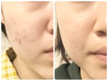 ラウン 京都(ROUN')/約1年の施術ビフォーアフター