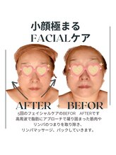 サロンド ヴィーナス 葛西店/ハイパーナイフフェイシャル小顔