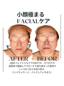 サロンド ヴィーナス 葛西店/ハイパーナイフフェイシャル小顔