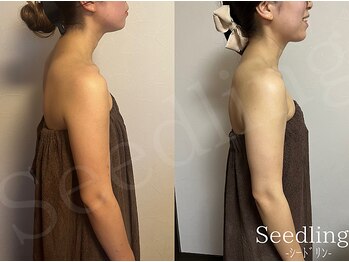 シードリン(Seedling)/ブライダル