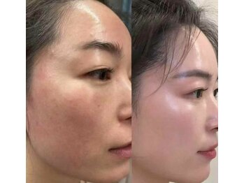 スターティス(STATICE)/オーダーメイド肌質改善