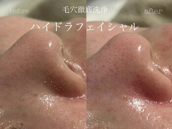 キアラ(CHIARA)/ハイドラフェイシャル