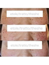 エトル(etole)/フォト美顔イオン導入＆トリプル