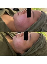 シーアイエステティック 船橋駅前店(c.iエステティック)/お顔のハーブピーリング♪