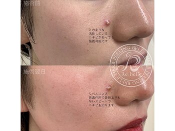 ハーバリー ハーブピーリング 岐阜(HERBERRYハーブピーリング)/ハーブピーリング専門店HERBERRY