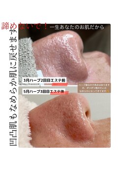 プラスエム(+M)/ボコボコ肌さようなら！