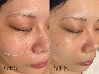 ブルーエム 大森(Blue-M)/ハーブピーリング2回施術