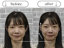 ビースタイル(B-style)/【美容鍼灸】ビフォーアフター