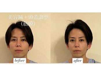 ヤマモト 表参道院(YAMAMOTO)/美容鍼＋頭蓋調整＋頸椎調整