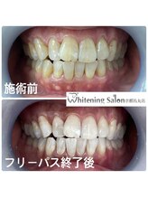 ホワイトニングサロン 京都烏丸店/ホワイトニング施術例