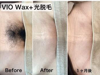 ルシェリ(Lecheri)/大人気☆VIO Wax+光脱毛♪