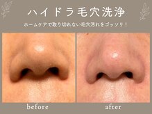 ルアイナ 吉祥寺(Ruaina)/ハイドラ毛穴洗浄/before&after