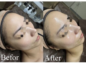 レア 姫路店(le'a)/ラミネーションピール