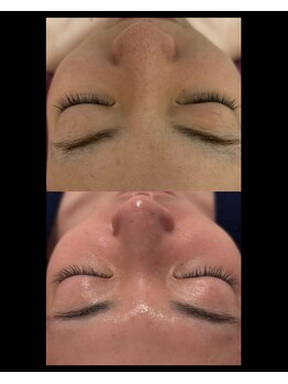 ビューティーサロン アンジェリークの写真/SNSで大人気のハーブピーリング★認定講師在籍で口コミ評価◎【REVI(ルヴィ)1ｇ陶肌トリートメント¥5,500】