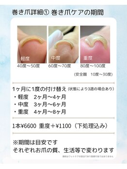 巻き爪フットケアサロン 神楽坂/巻き爪詳細1