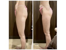 サロン ド リドミ 新瑞橋店(Salon de ridomi)の雰囲気（痩身　むくみ　血行促進　代謝アップ　効果有りのハイパーナイフ）