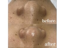 サロン ド ソワン(salon de soin)/毛穴エクストラクション