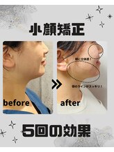 めいてる/小顔矯正/お顔の左右差/大阪市