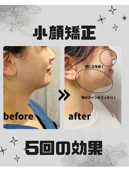 めいてる/小顔矯正/お顔の左右差/大阪市