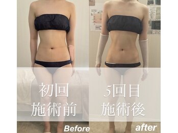 ミセル(MISEL2nd)/キープ力◎リピートNo.1最新痩身