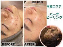 ハーブピーリングで毛穴肌悩みのない人生を