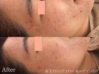 サロンヴェアリー 広尾(salon vary)/水玉リフティングホワイトハーブ