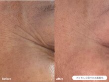 フォンビューティー(fon beauty)/しわケア６ヶ月・6回