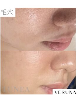 ルネア(LUNEA)の写真/【棘で肌質改善×育毛促進】肌も頭皮も本格エイジングケアできる本格ハーブピーリング専門サロン◇