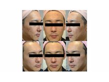 グリーンノート(GREEN NOTE)/ハ－ブピ－リング