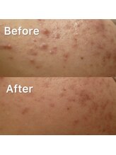 サーティースリー 横浜元町(Thirty3)/IPLフェイシャル Before/After