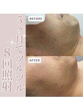 美容脱毛専門サロン エピラージュ 新宿店(Epilage)/ヒゲ脱毛