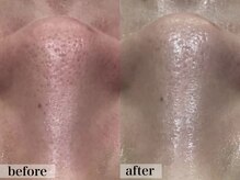 エステサロン ジョアアンジェ(joie ange)/イラストリアス　1回